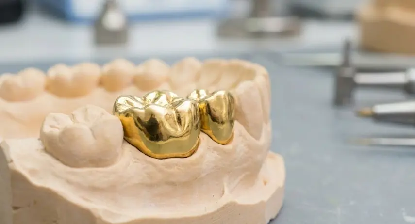 dental model üzerinde hassas işlenmiş altın taçlar