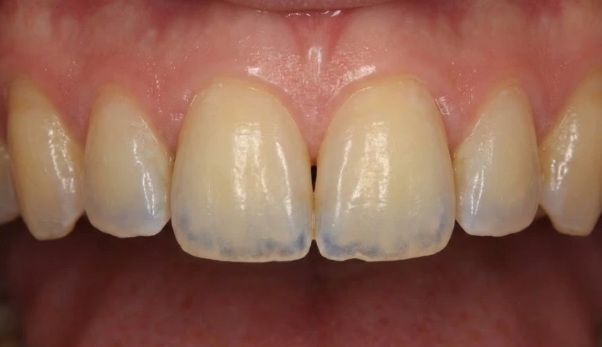 signs-of-severe-enamel-erosion