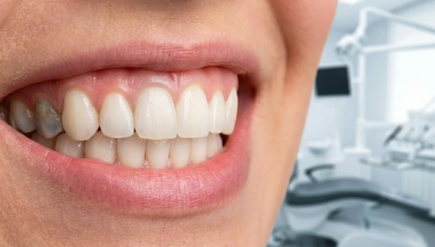 single-dark-molar-visible