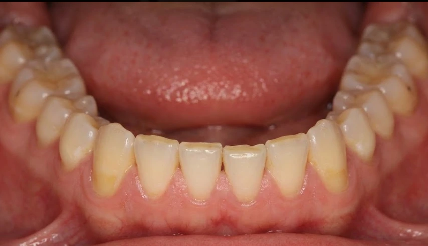 teeth-worn-from-chronic-grinding