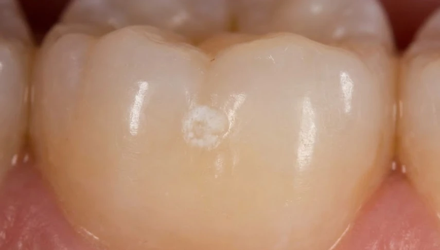 the-early-slow-enamel-phase