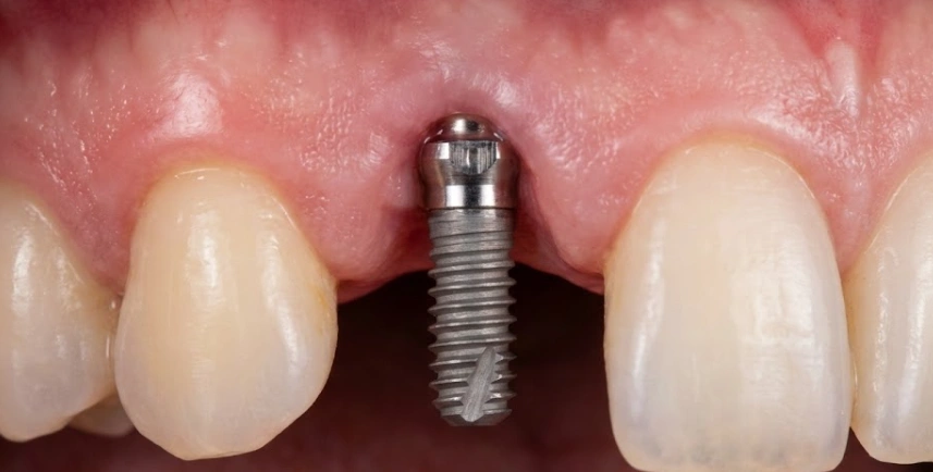 titanium-dental-implant-post