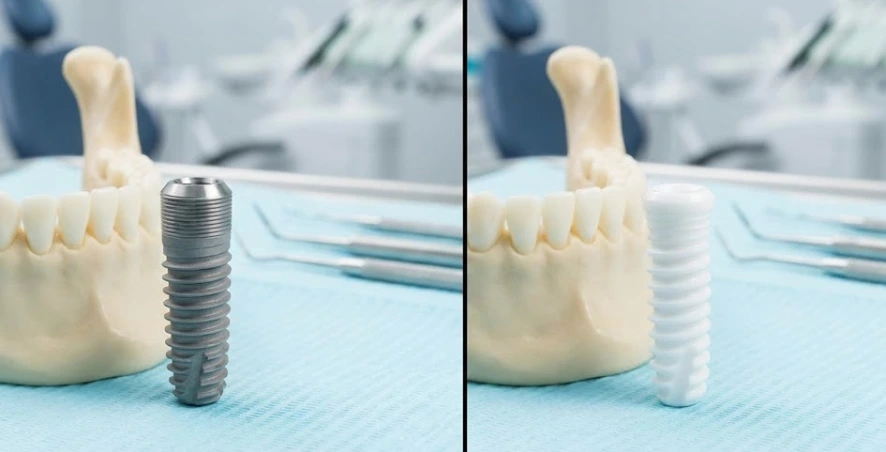 titanium-vs-zirconia-implants-which-material-is-right-for-you