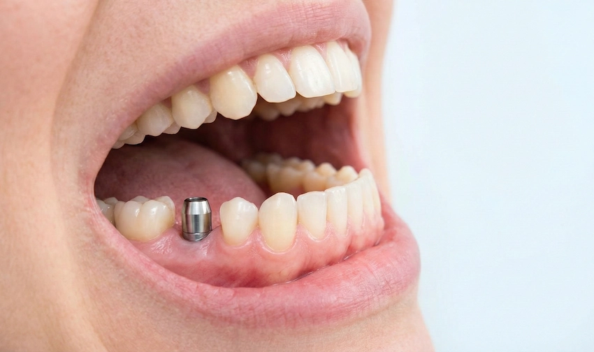 Extraction dentaire et implantation en une journée