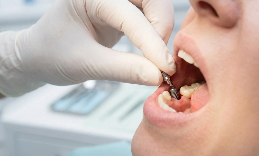 Extraction dentaire et implantation