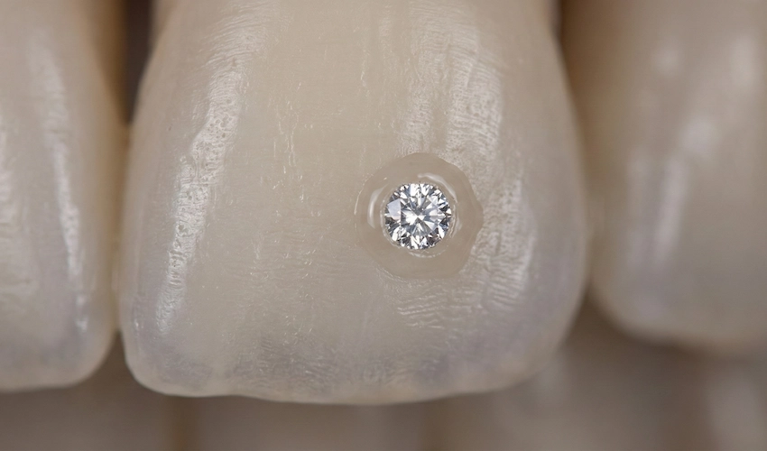 tooth gem no drill bonded enamel macro