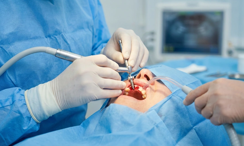 tratamiento de implante dental trans nasal