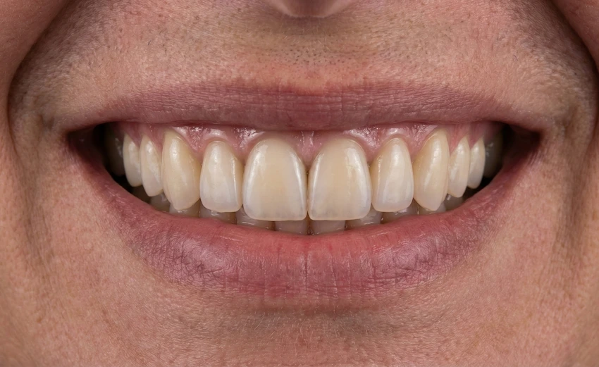 zrozumienie stałej hybrydowej protezy