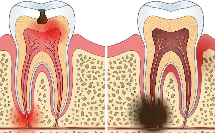 untreated infection leads to abscess