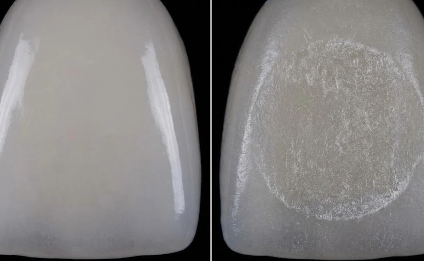 veneer glaze damaged for bonding