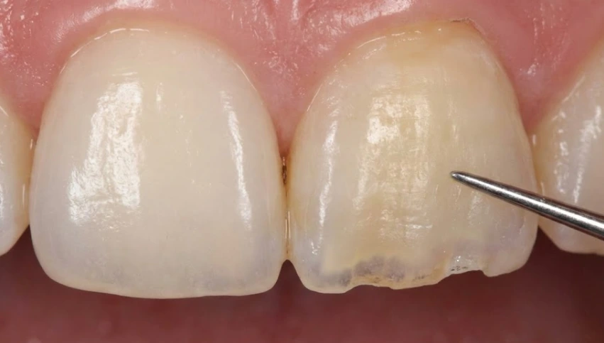 visible-enamel-acid-erosion