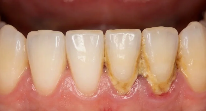 visible-tartar-buildup-on-teeth