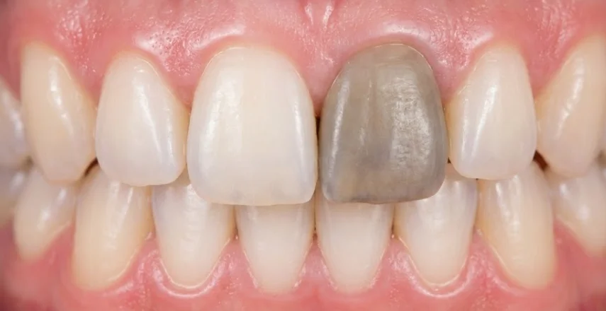 dent visiblement grise parmi des dents blanches saines