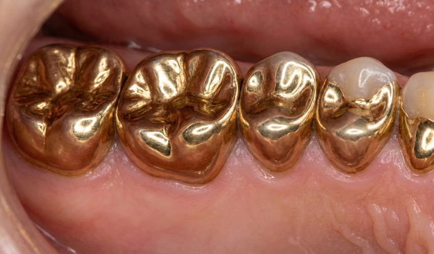 why choose turkey for gold restorations