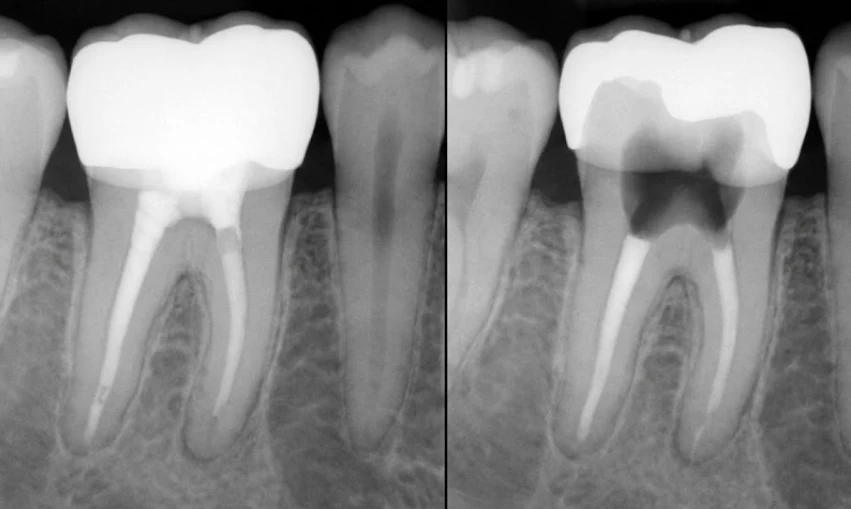 рентген, показывающий скрытый кариес под коронкой