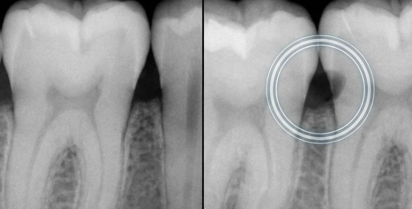 x-rays-reveal-hidden-tooth-decay