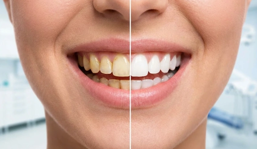 yellow-teeth-transformed-to-white