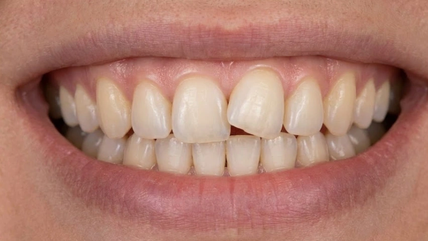 dal close-up di un sorriso con un dente storto