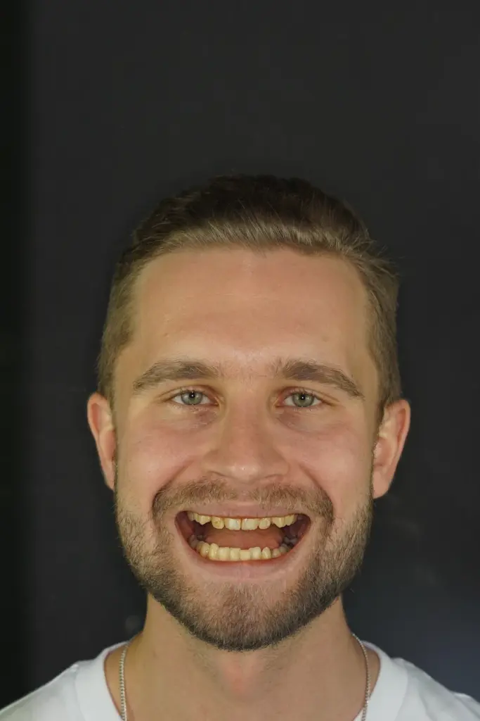 dientes de artürs valdmanis 2025