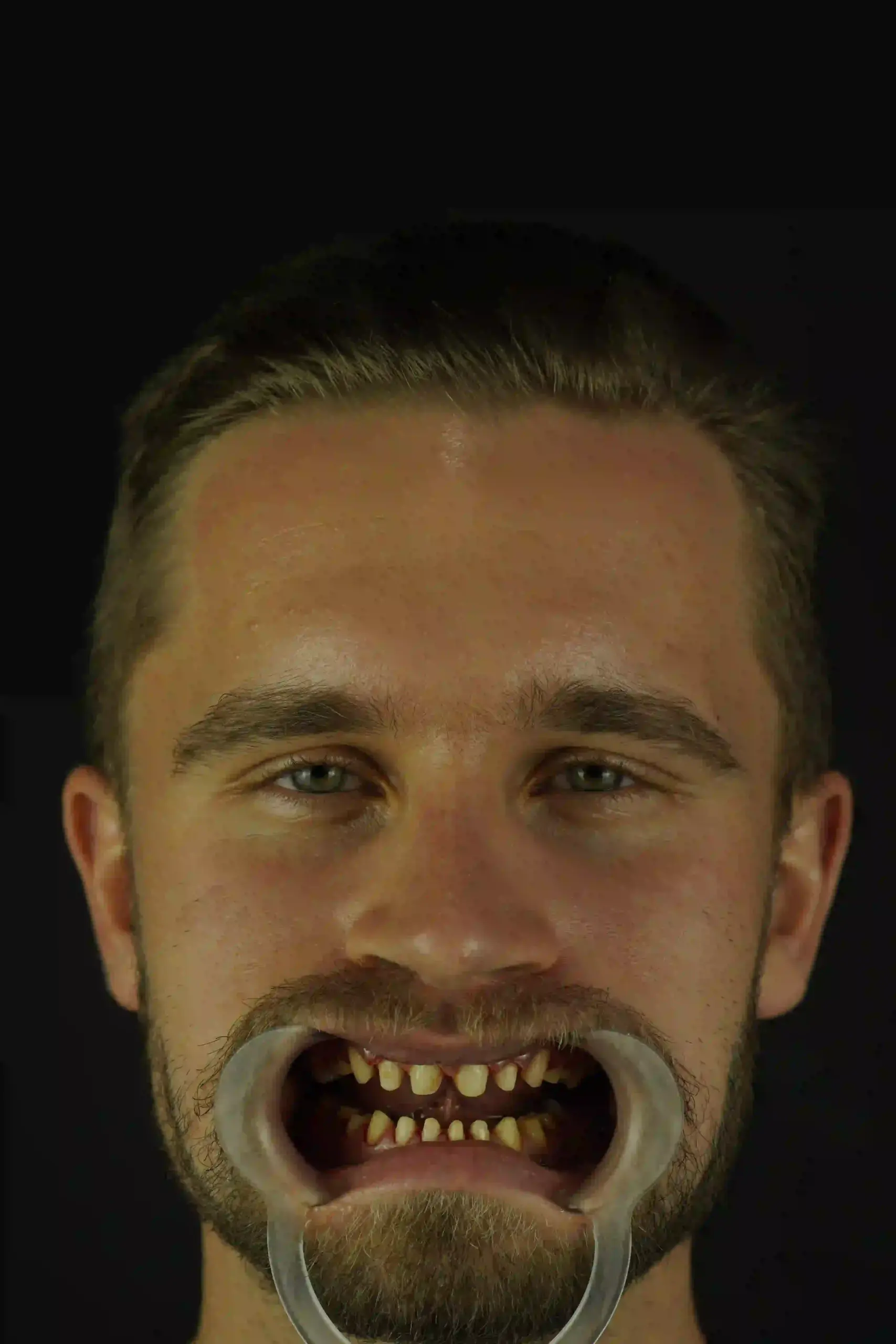 artürs valdmanis teeth before