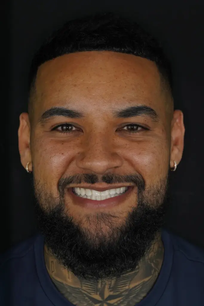 benjamin richards everton teeth after