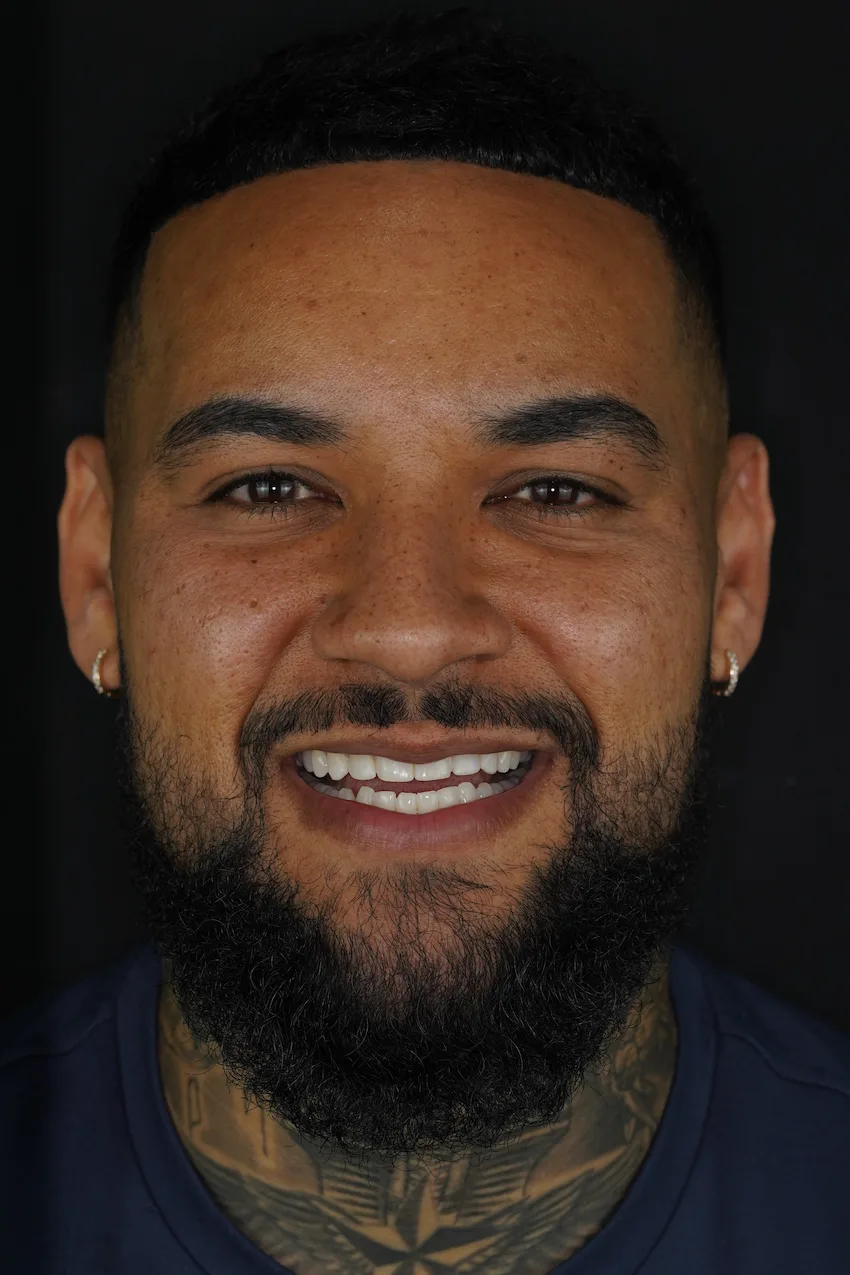 benjamin richards everton teeth after