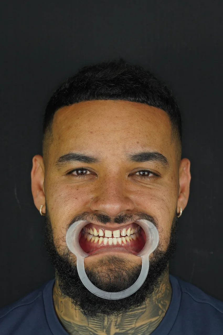 benjamin richards everton teeth before