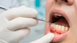 checking for signs of stress related gum disease