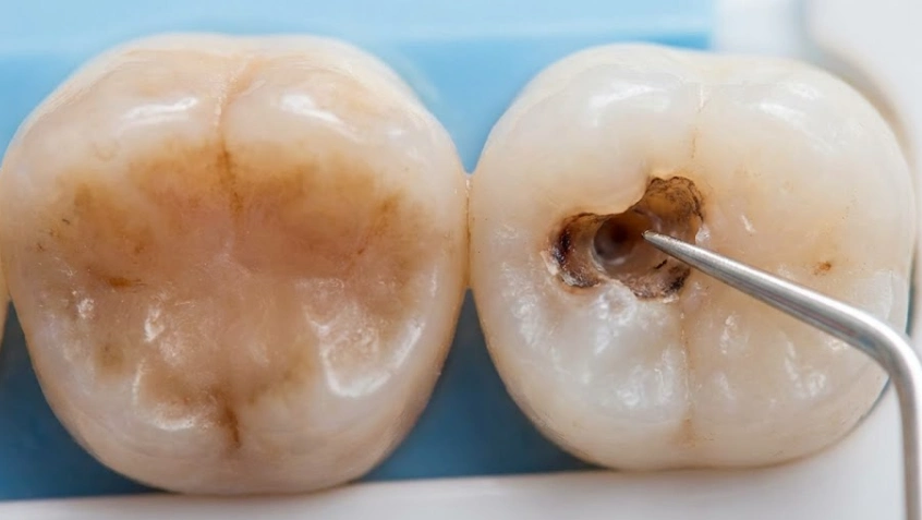 controllo della carie appiccicosa con uno strumento dentale