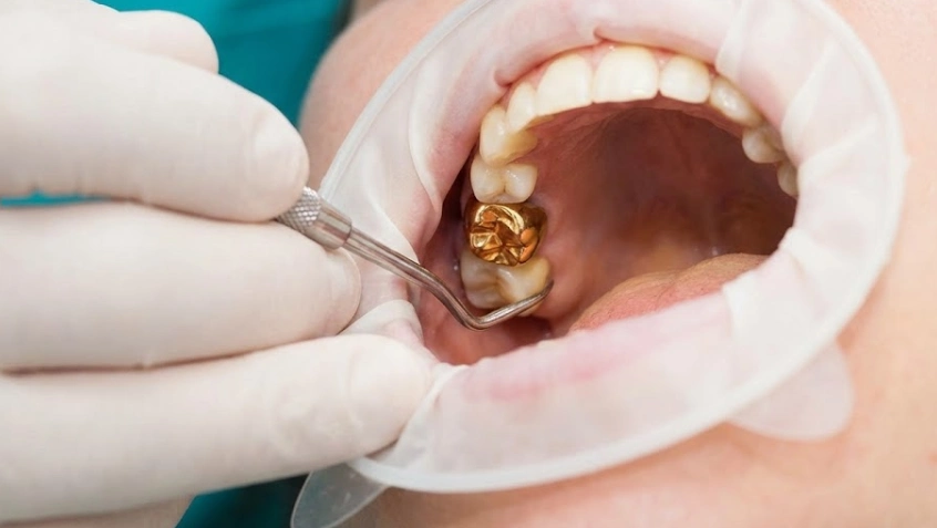 examen clínico de una corona de oro