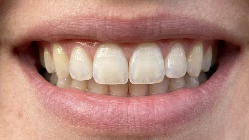 primo piano di bordi di denti traslucidi