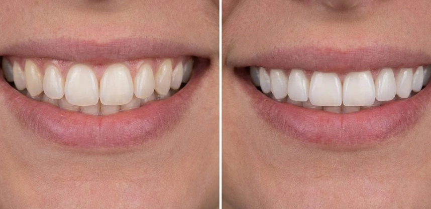 comparación de dientes redondeados versus cuadrados