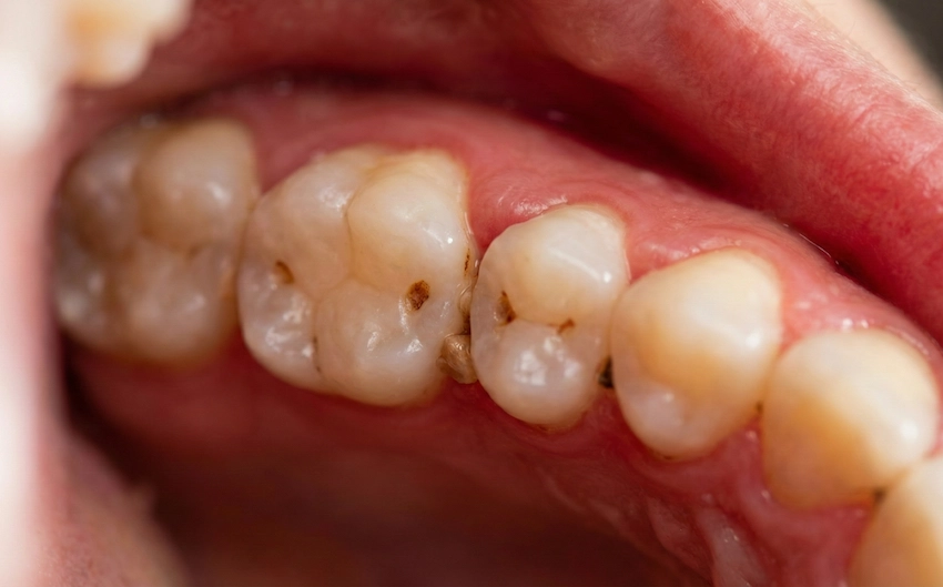 muels molares apiñados trampa de comida caries temprana