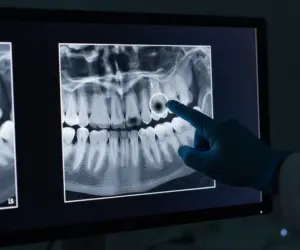dental cbct scan molar root abscess