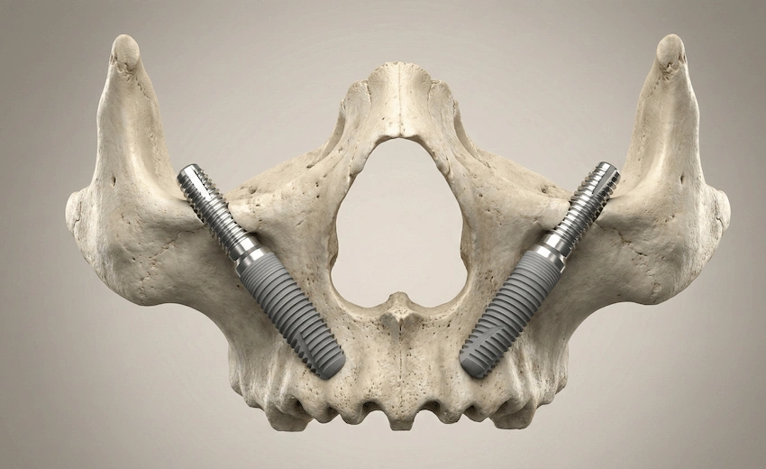 implante dental sin hueso