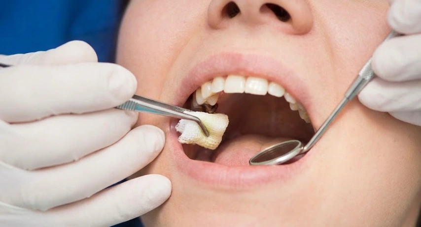 dentista aplicando un apósito medicado