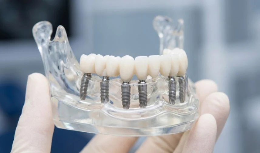 dentist holding all on 8 jaw model