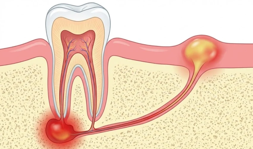 diagram van een geïnfecteerd tandvleesbult