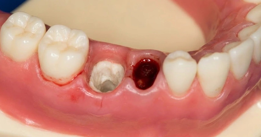 bolsa seca con hueso expuesto