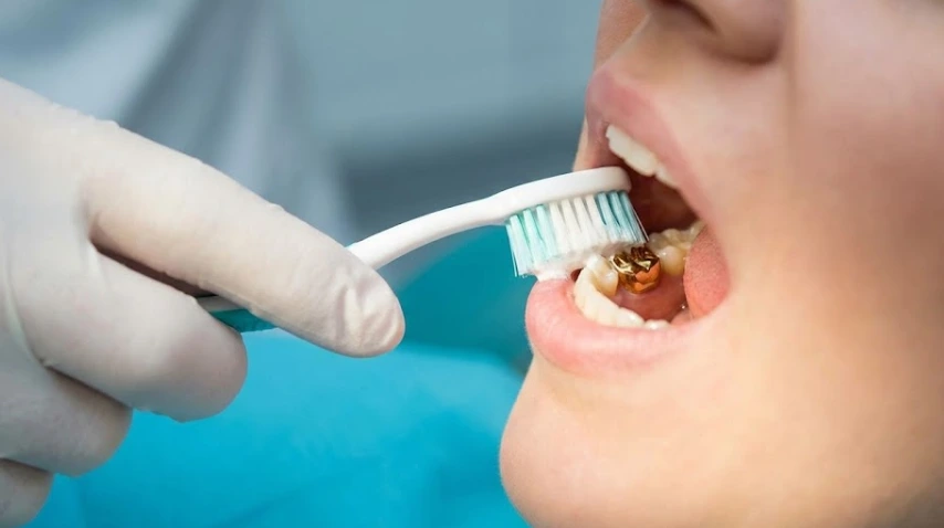 gentle brushing of a gold crown