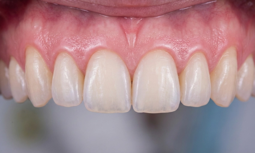 gingivoplastica contorno delle gengive dopo risultati