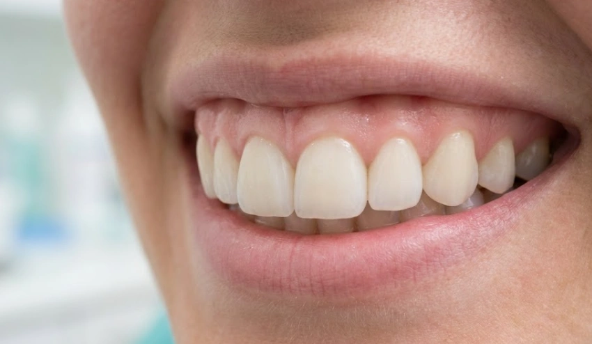 healthy-gums-with-precision-veneers