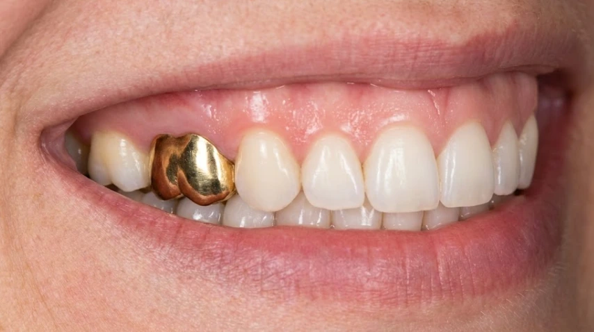 sonrisa saludable integrada con corona de oro