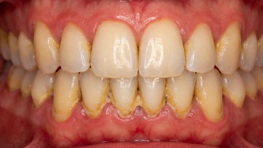 heavy tartar buildup causing inflamed gums
