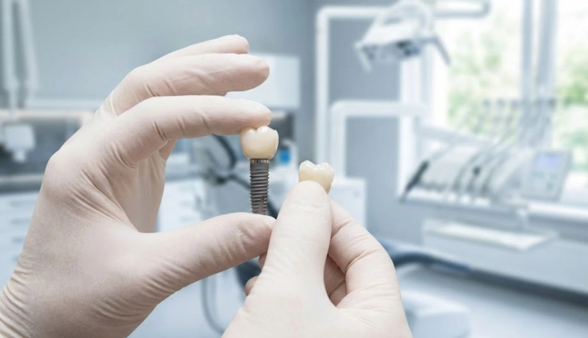 implant en titane de haute qualité et couronne