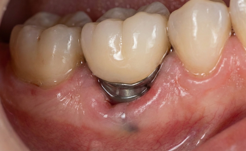 recesiune gingivală a implantului și pierdere osoasă