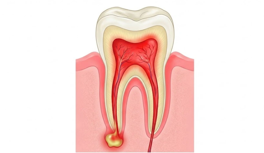 infected-tooth-with-a-root-abscess