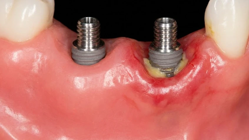 φλεγμονώδης ούλα γύρω από δόντινο εμφύτευμα
