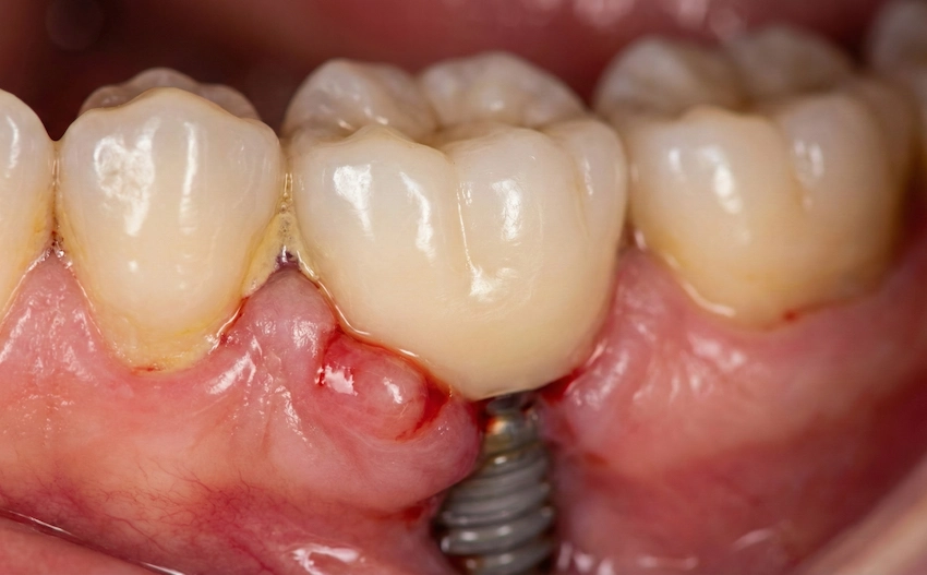 simptome inițiale peri-implantitis roșeață