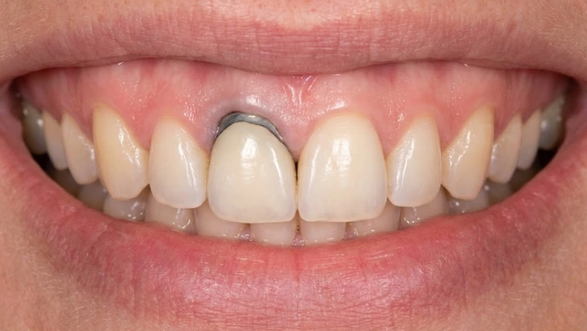 pfm crown with dark gumline